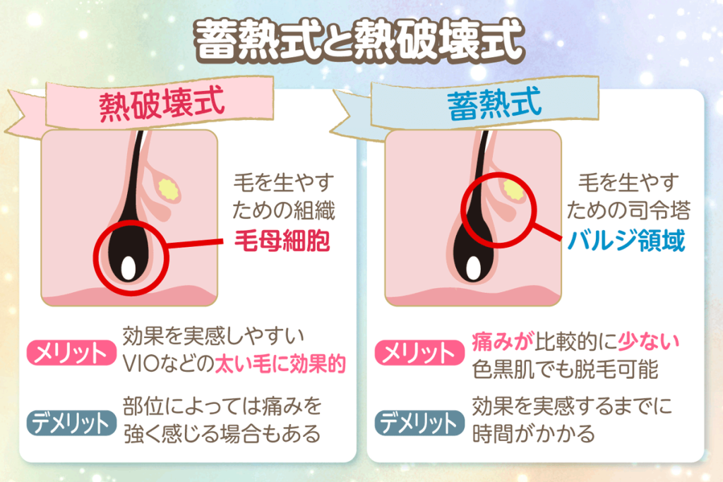 医療脱毛機の蓄熱式と熱破壊式の違いと特徴を図解で解説
