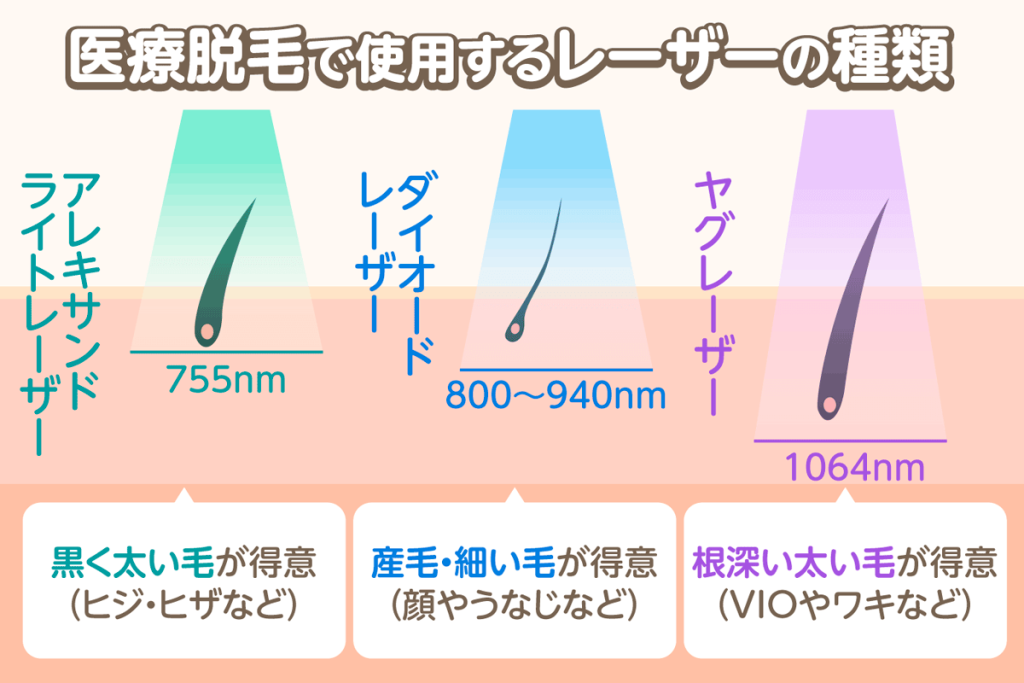 医療脱毛機のレーザー3種類の特徴を図解で解説